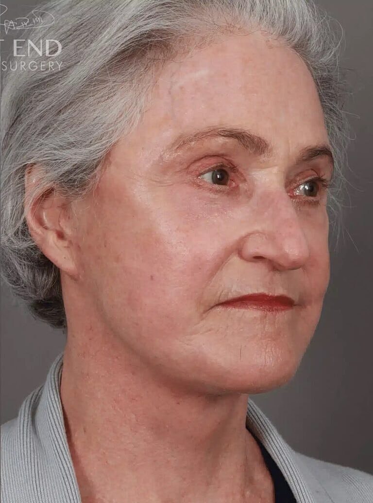 Facial Fat Transfer Before & After