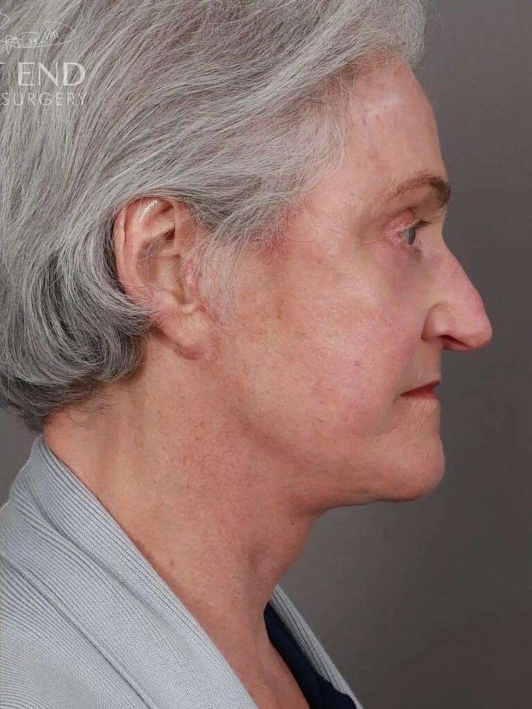 Facial Fat Transfer Before & After