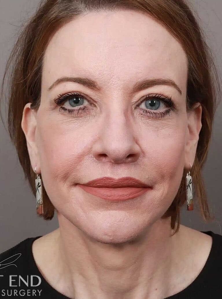 Facial Fat Transfer Before & After