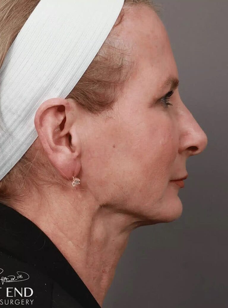 Facial Fat Transfer Before & After