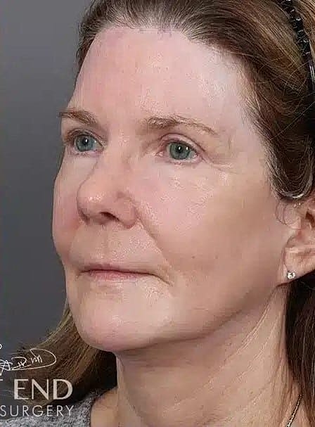 Facial Fat Transfer Before & After