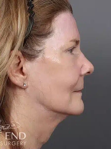 Facial Fat Transfer Before & After