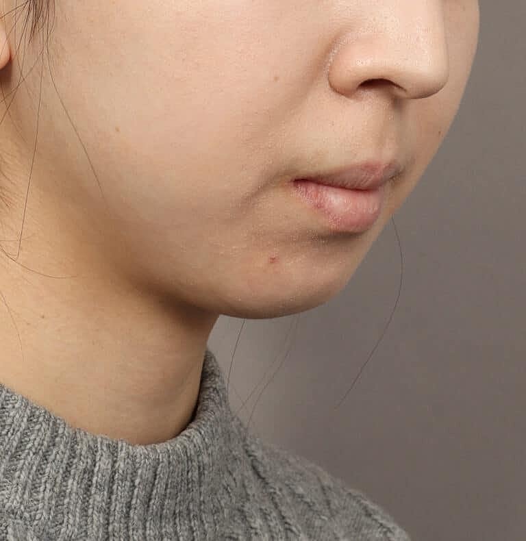 Chin Implant Before & After