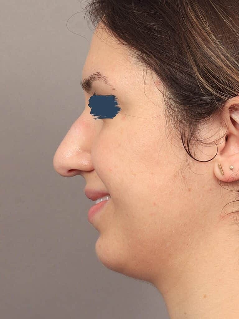 Chin Implant Before & After