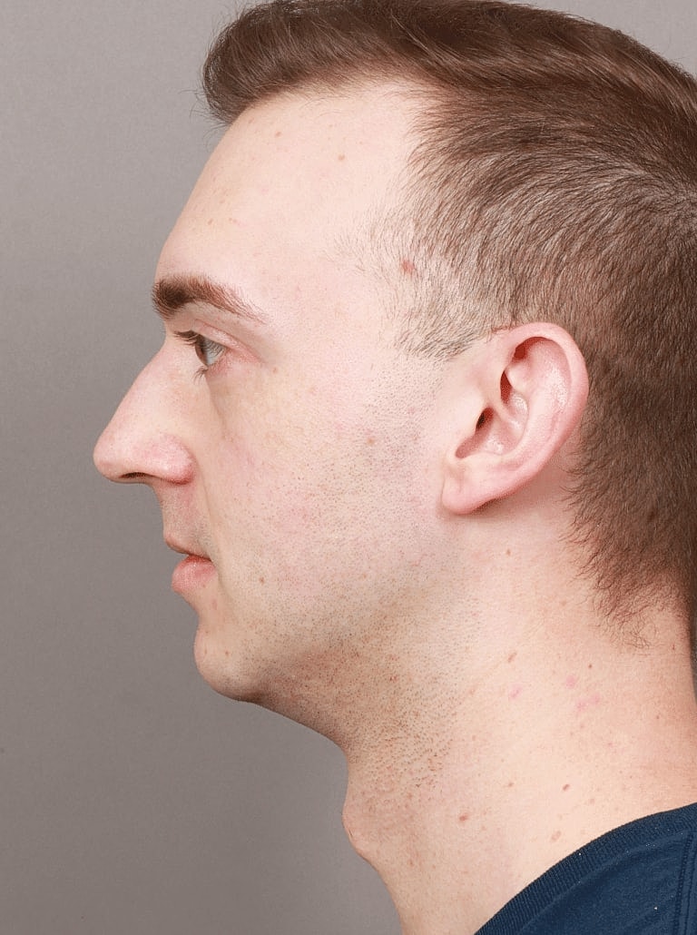 Chin Implant Before & After