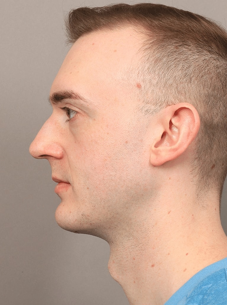 Chin Implant Before & After