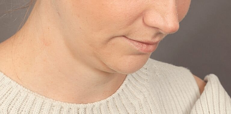 Chin Implant Before & After