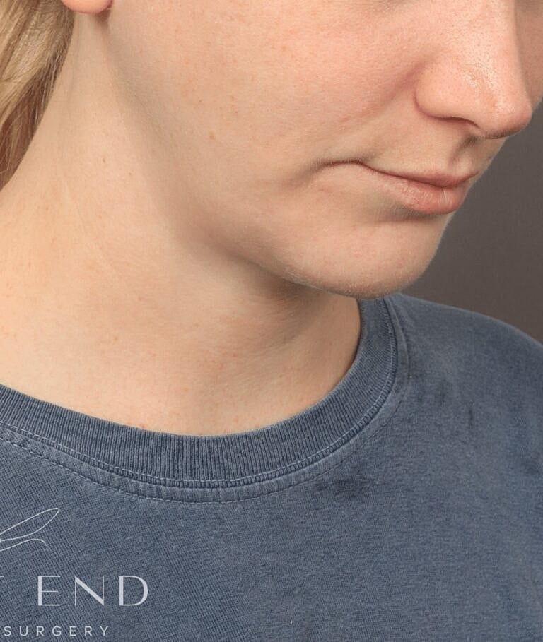 Chin Implant Before & After