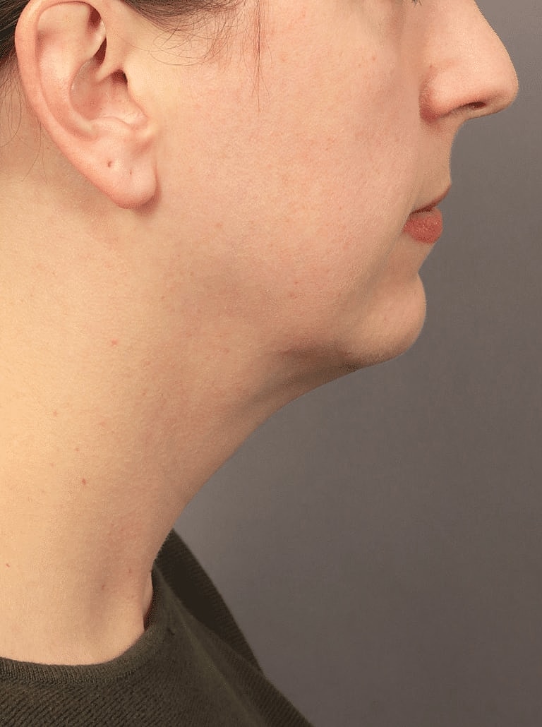 Chin Implant Before & After