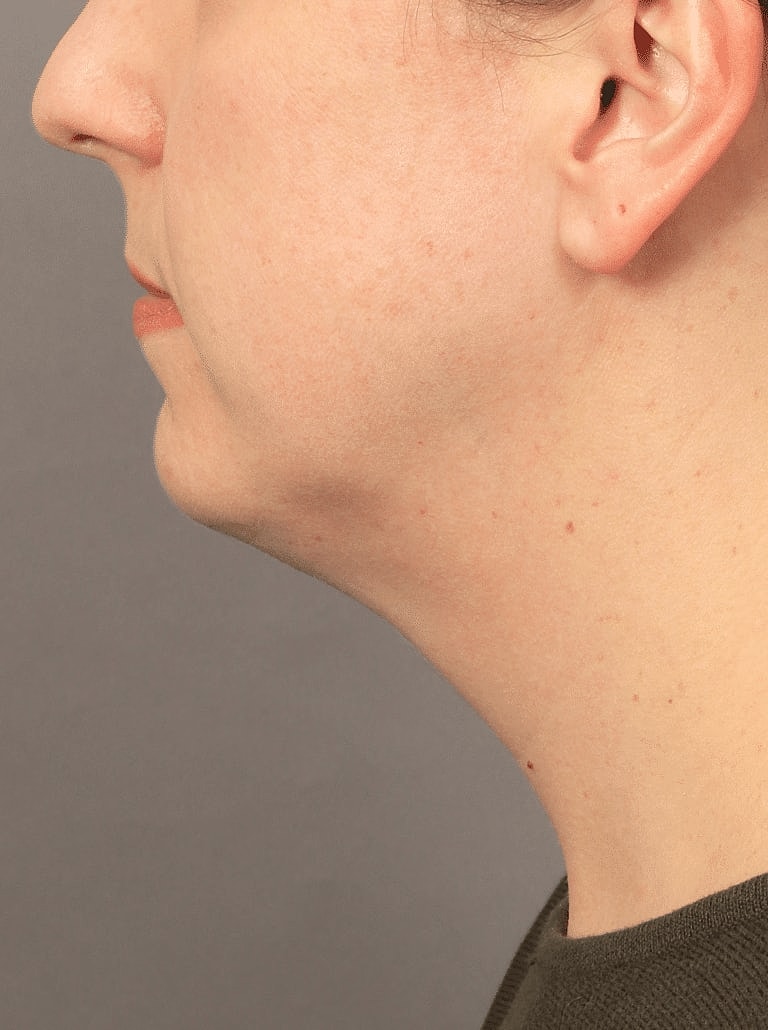 Chin Implant Before & After