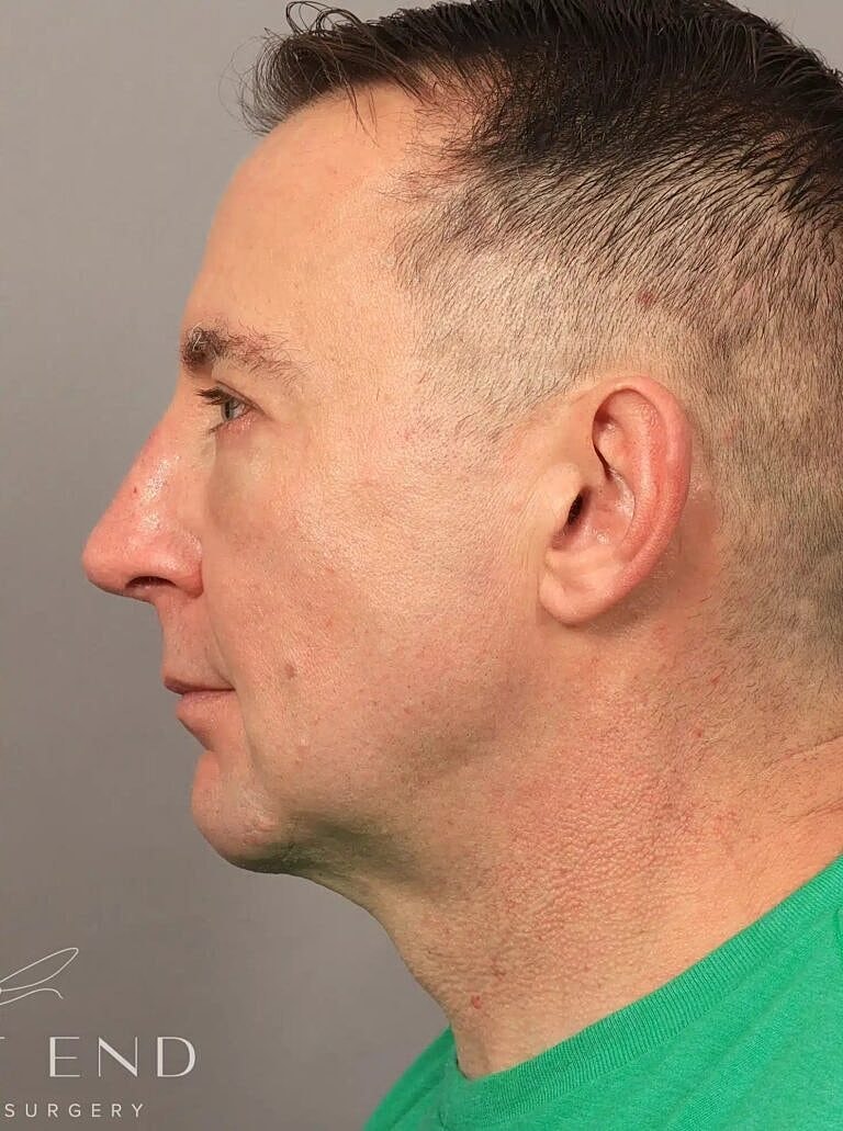 Chin Implant Before & After