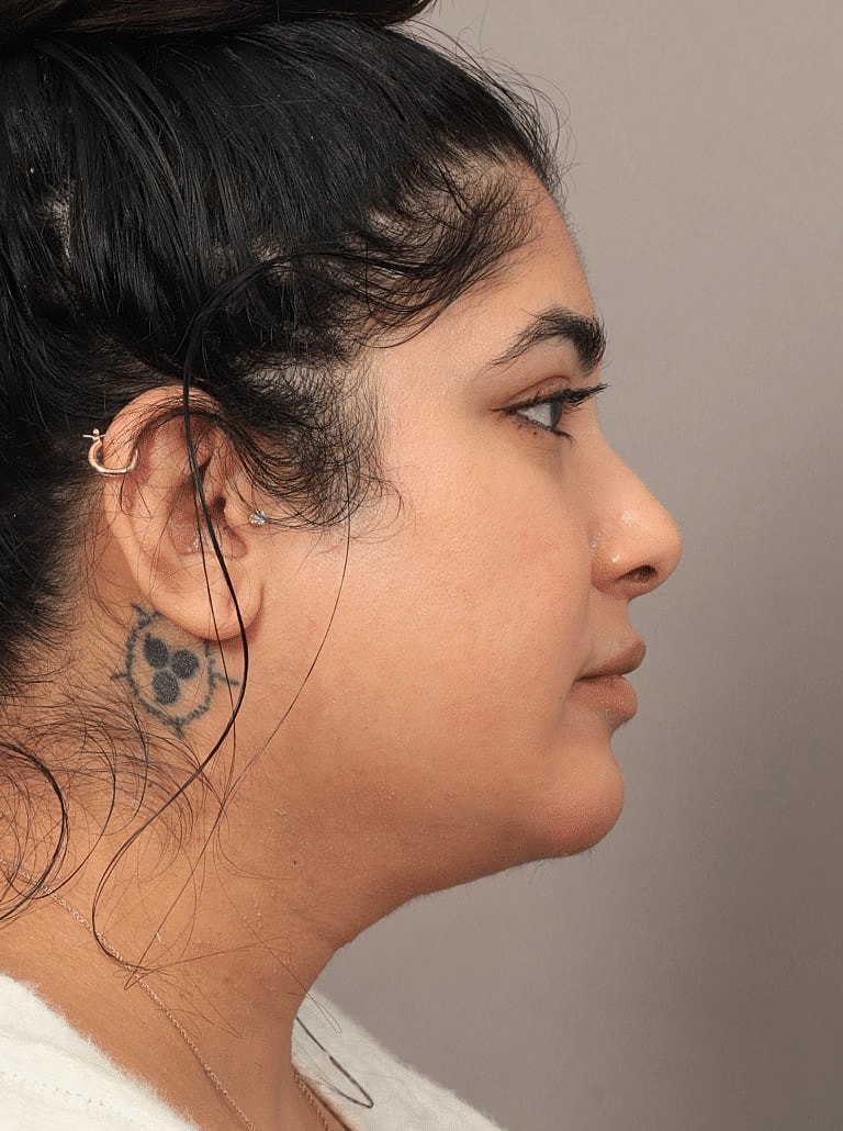 Chin Implant Before & After