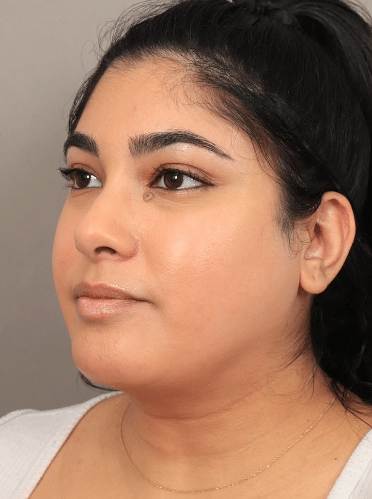 Chin Implant Before & After