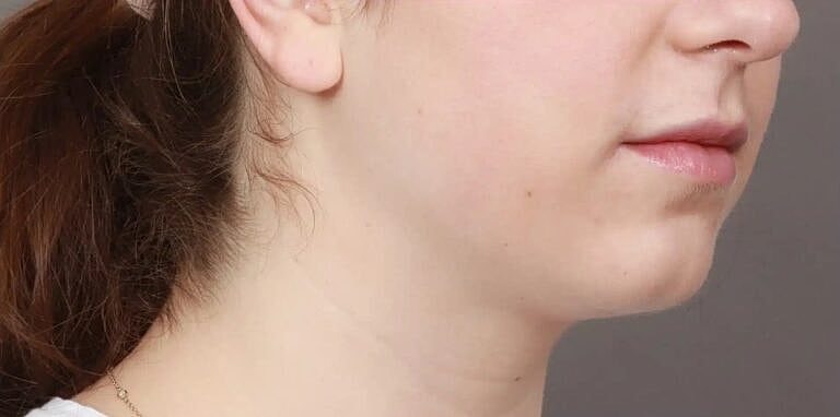 Chin Implant Before & After
