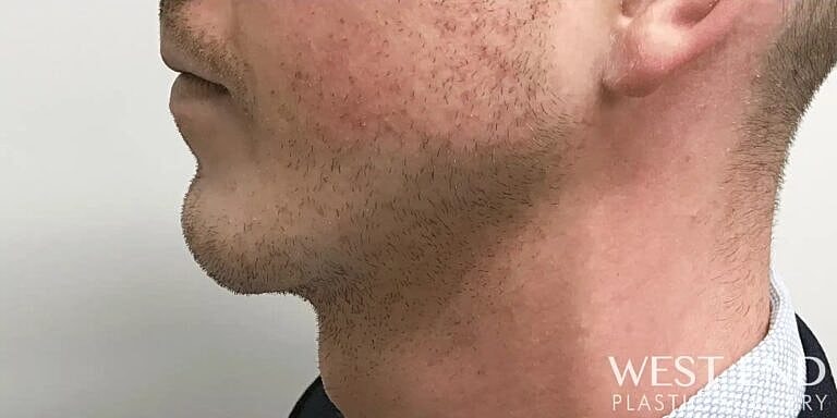 Chin Implant Before & After