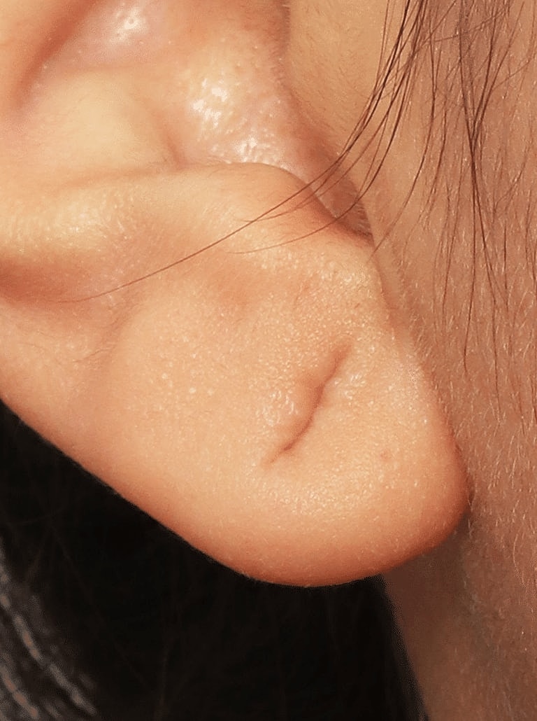Earlobe Repair Before & After