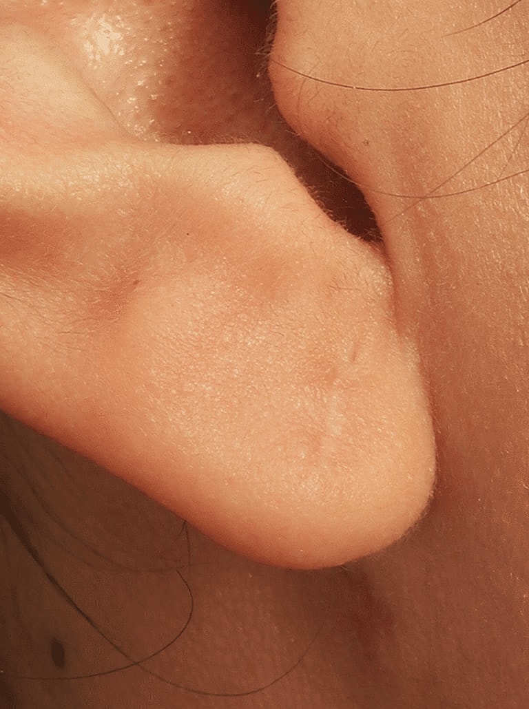 Earlobe Repair Before & After