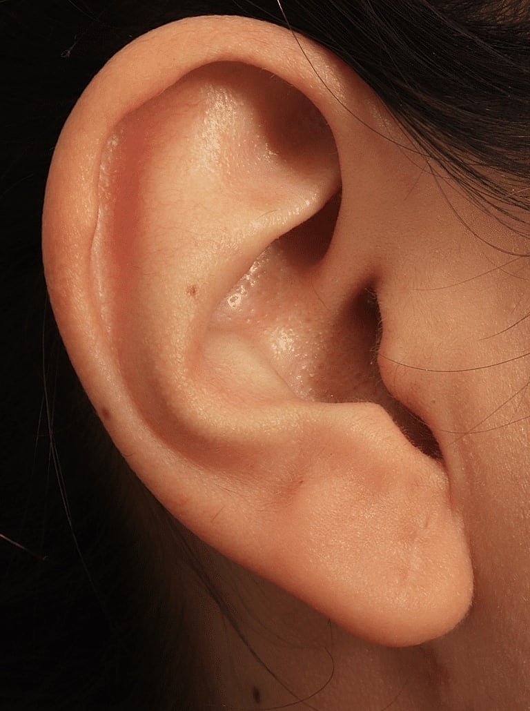 Earlobe Repair Before & After