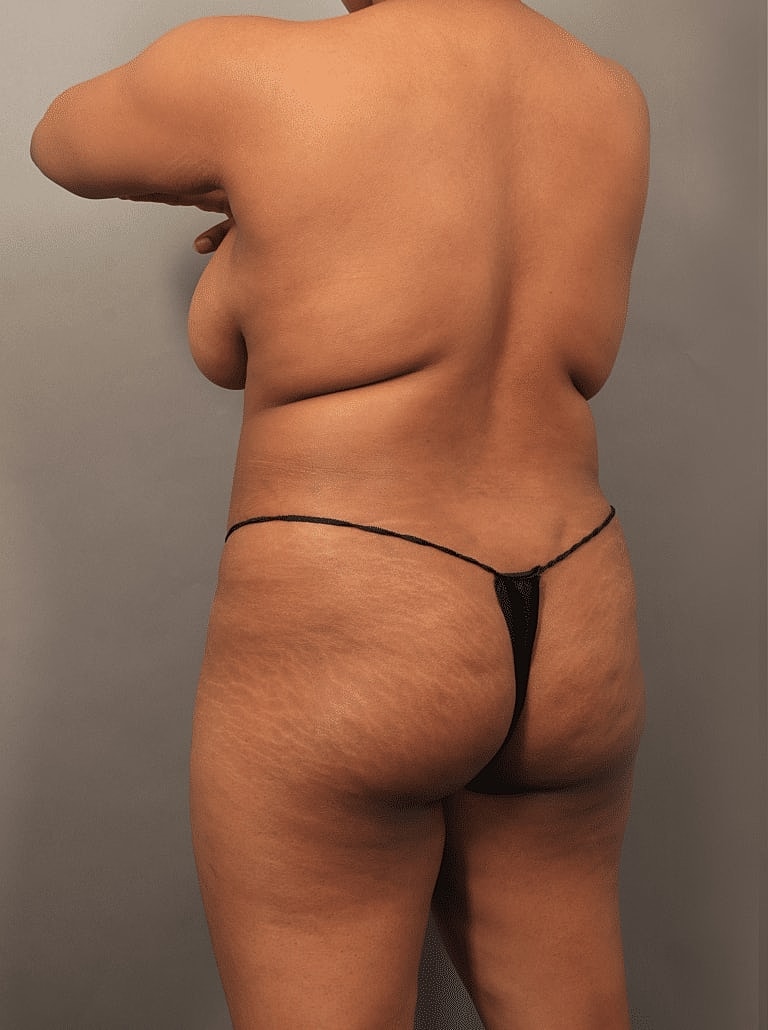 Liposuction Before & After