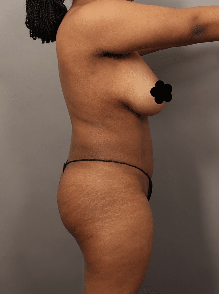 Liposuction Before & After