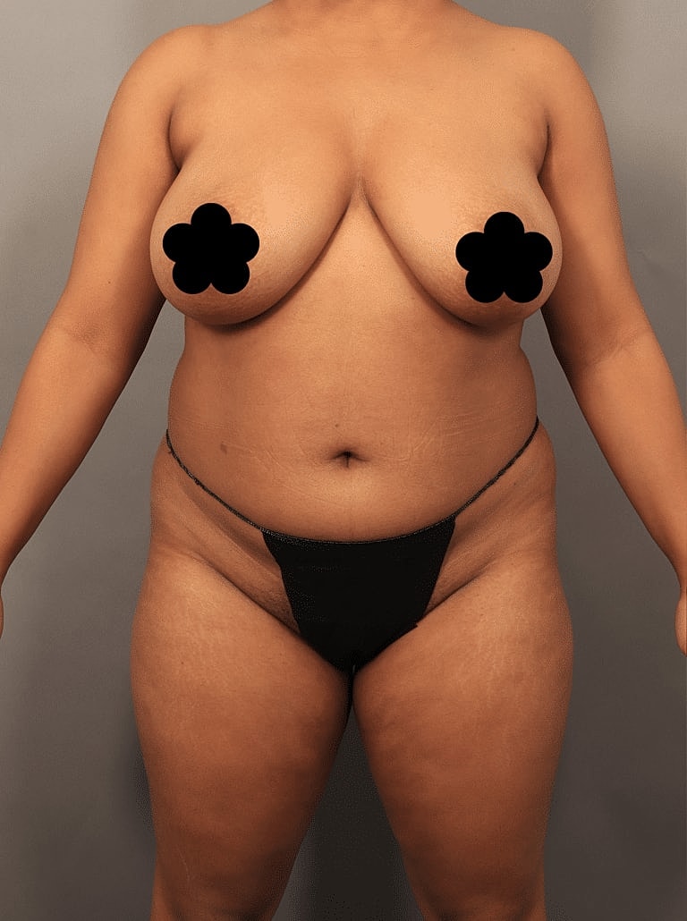 Liposuction Before & After