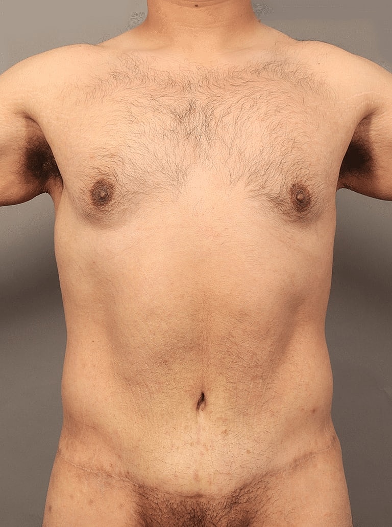 Liposuction Before & After
