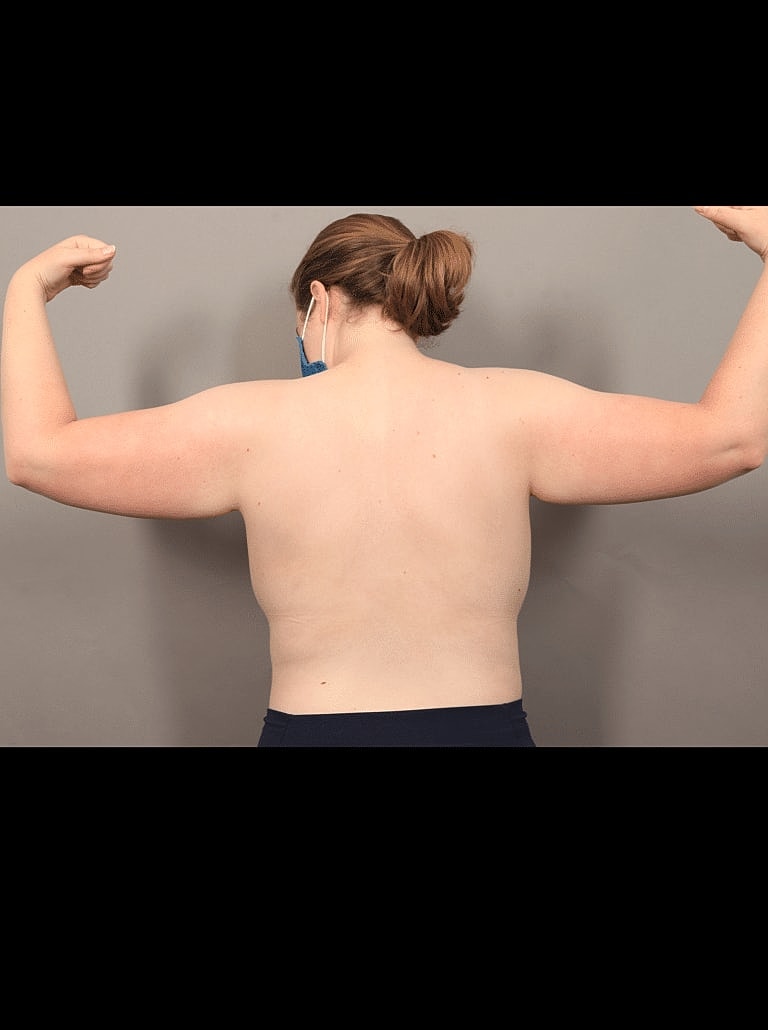 Liposuction Before & After