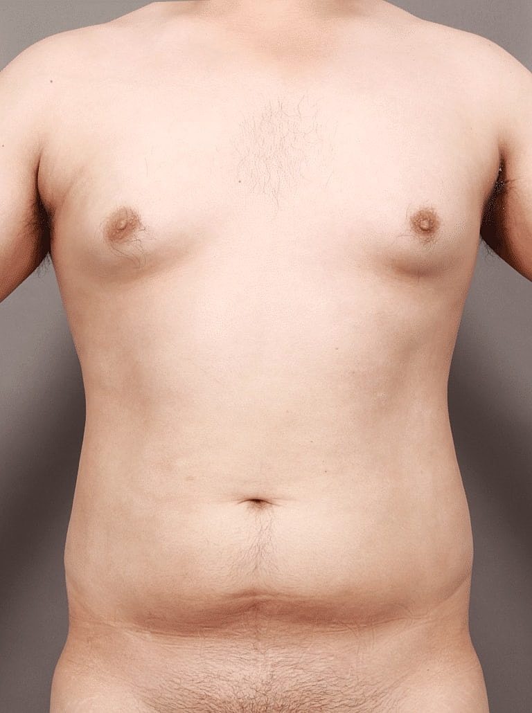 Liposuction Before & After