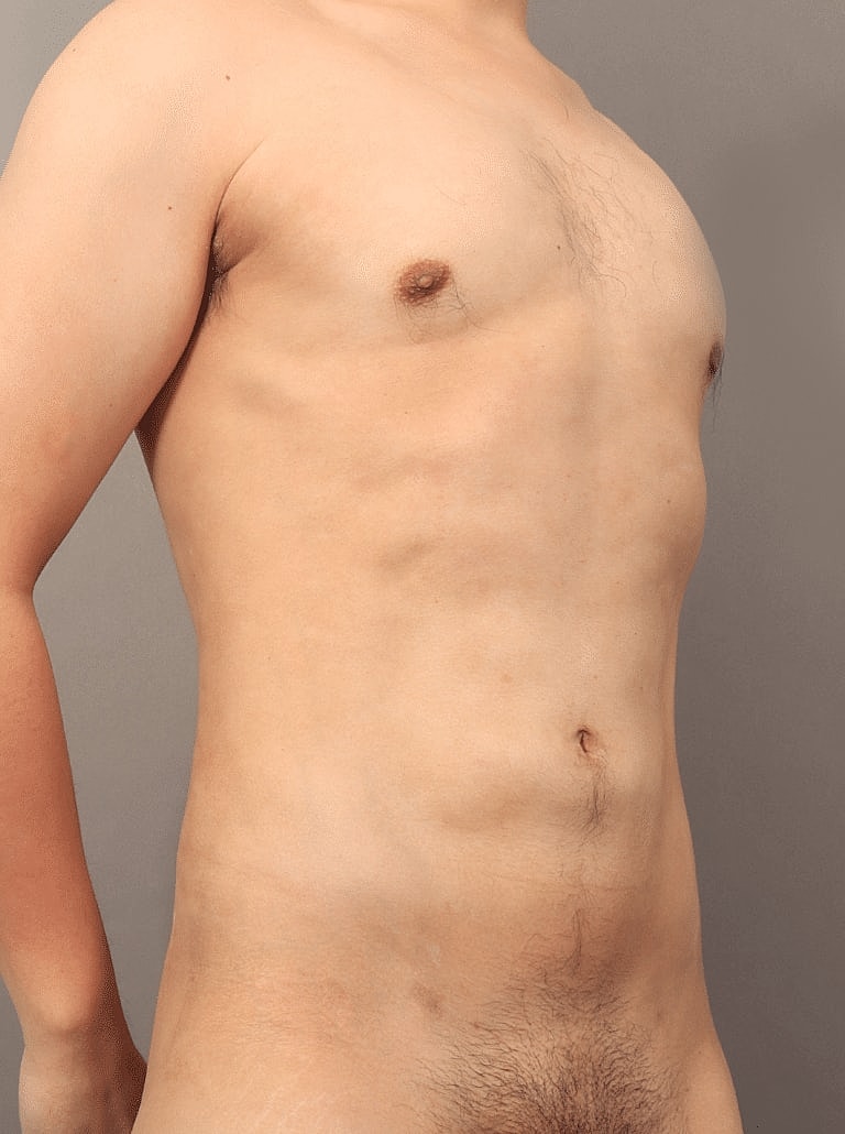 Liposuction Before & After