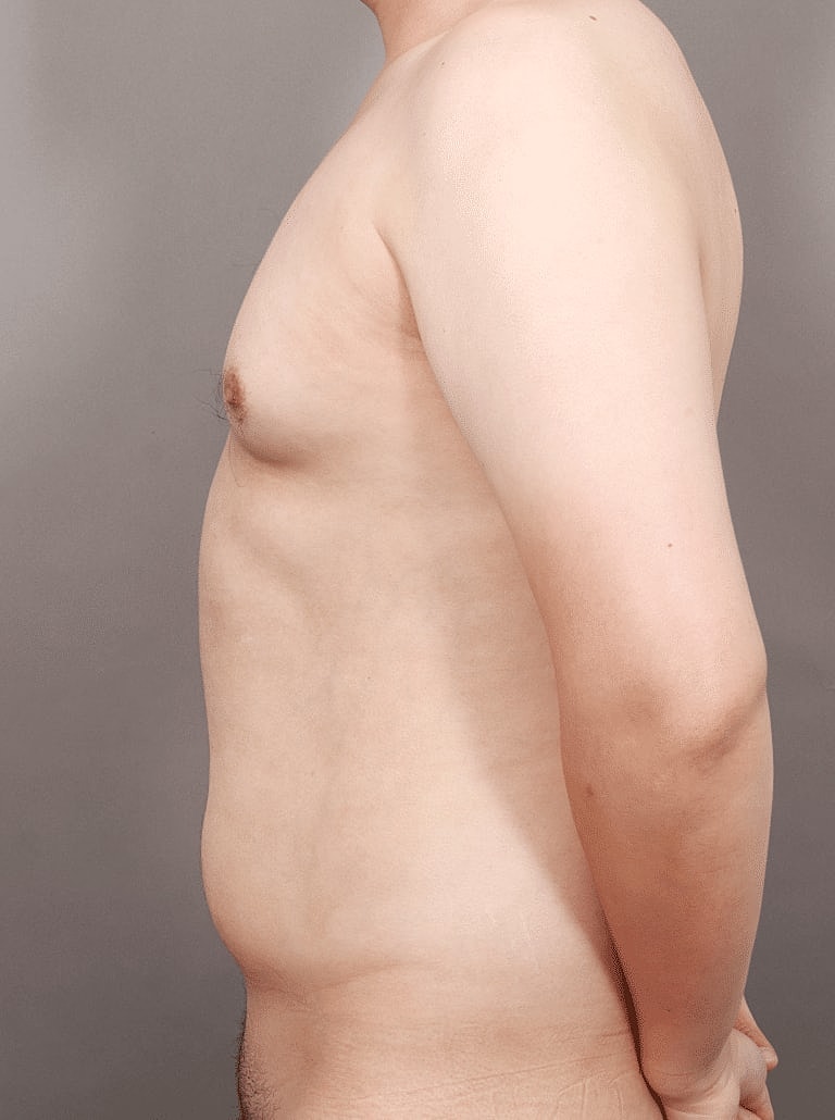Liposuction Before & After