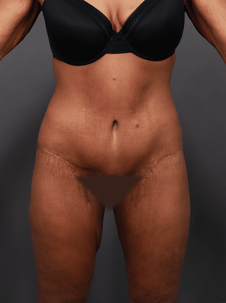 Liposuction Before & After