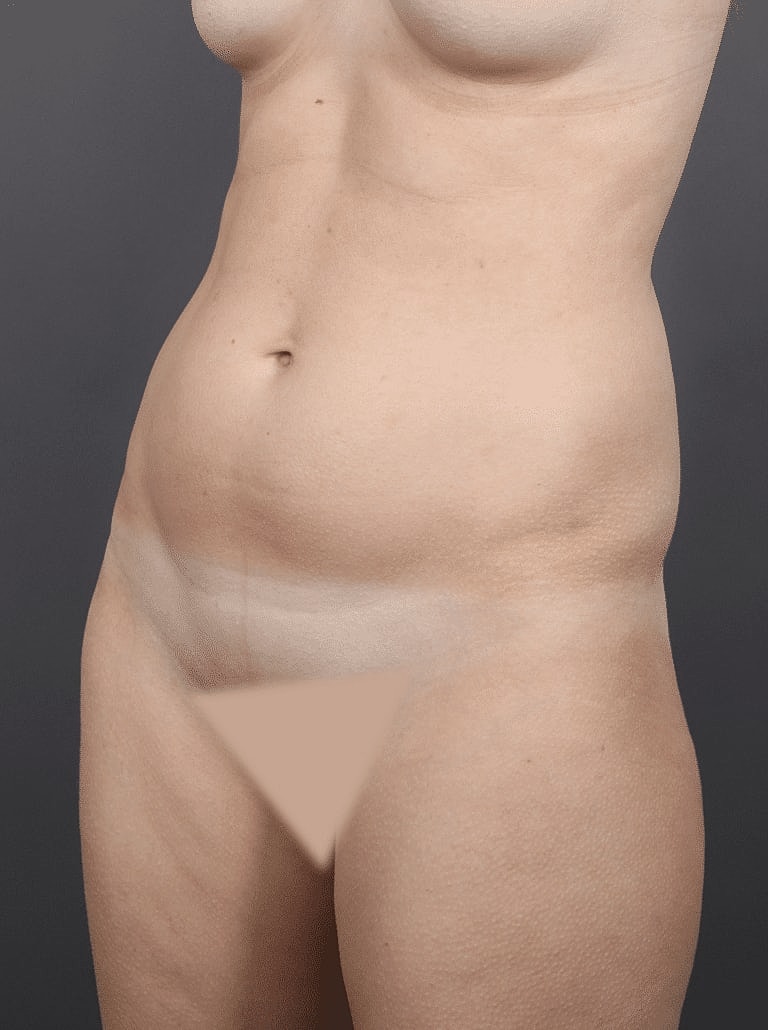 Liposuction Before & After