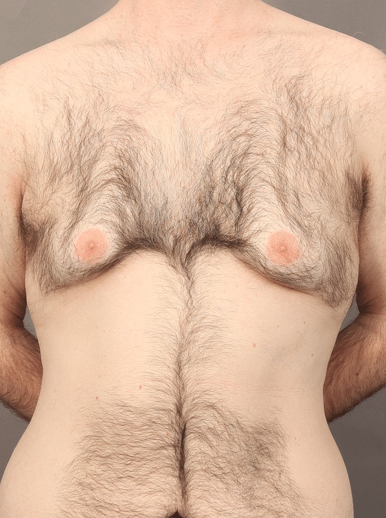 Liposuction Before & After