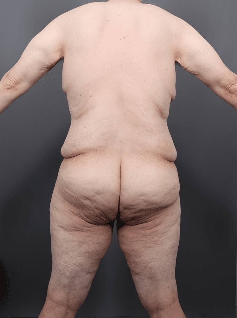 Liposuction Before & After