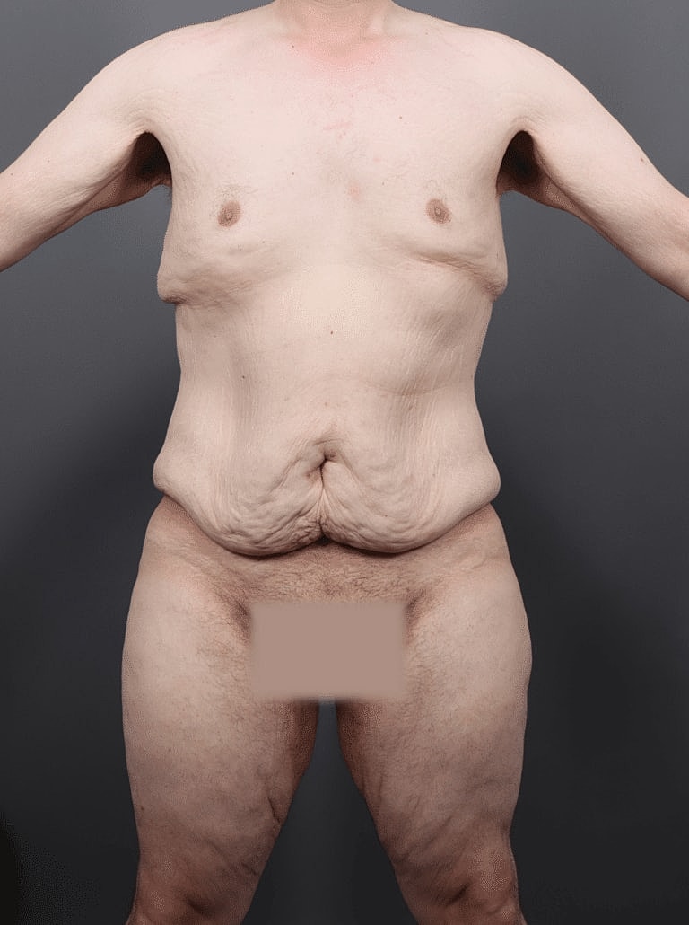 Liposuction Before & After