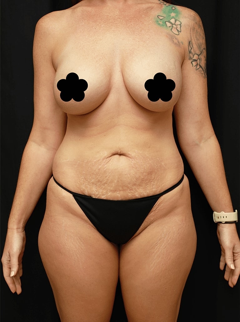 Liposuction Before & After