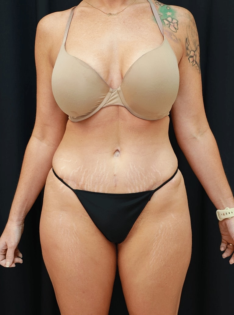 Liposuction Before & After
