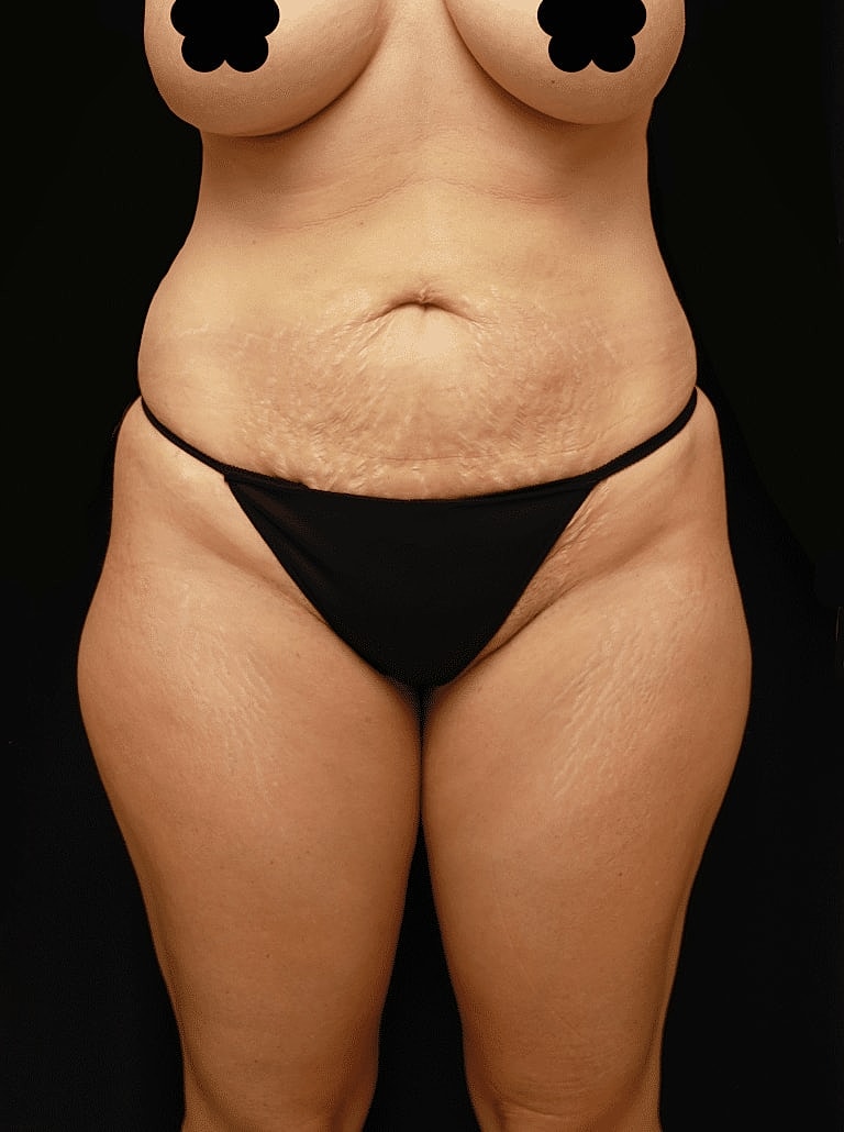 Liposuction Before & After