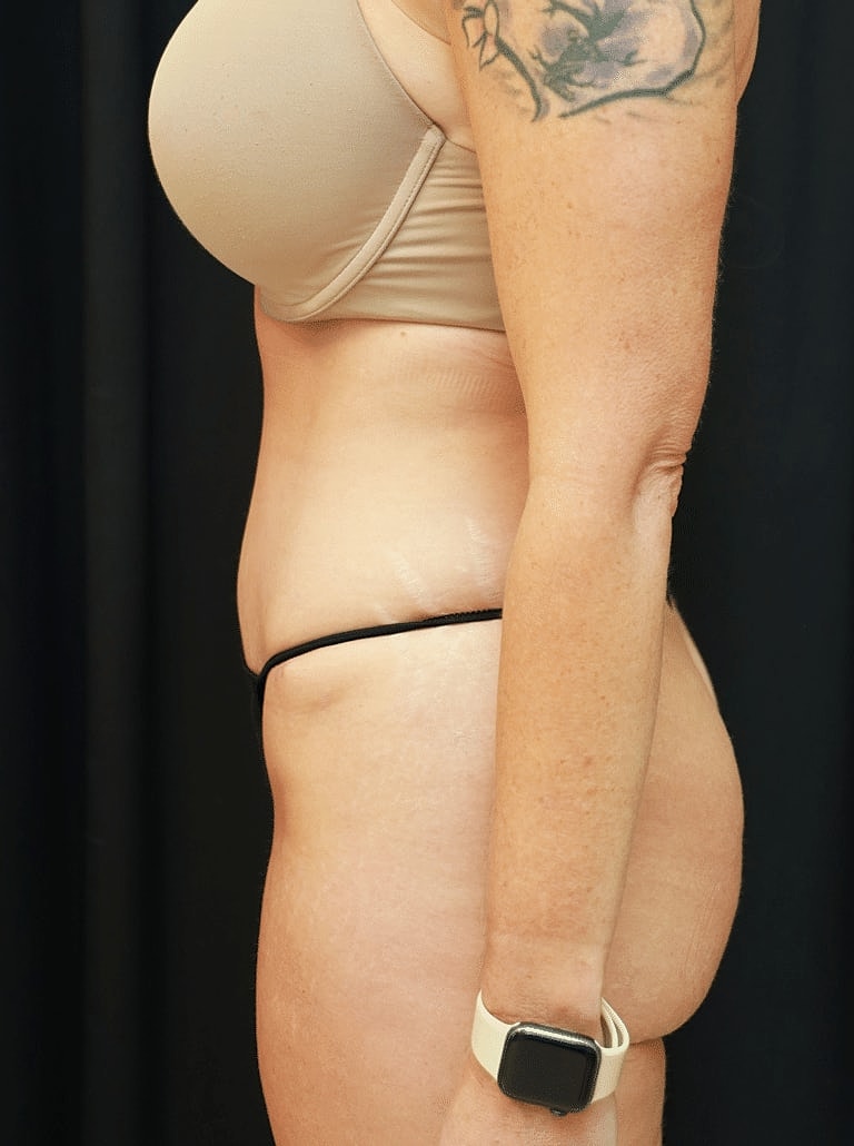 Liposuction Before & After
