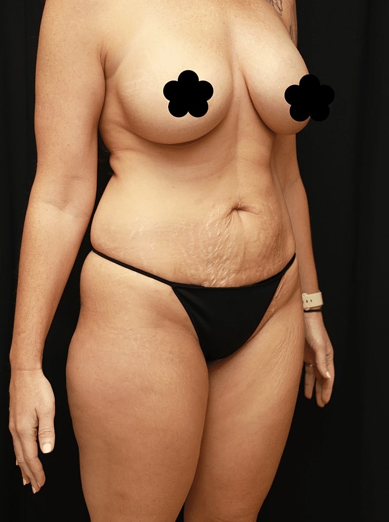 Liposuction Before & After