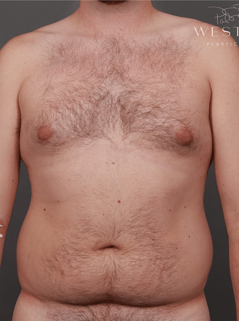 Liposuction Before & After
