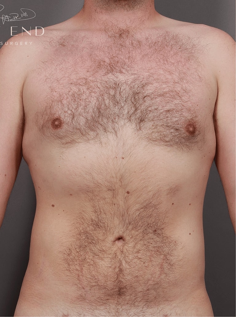 Liposuction Before & After