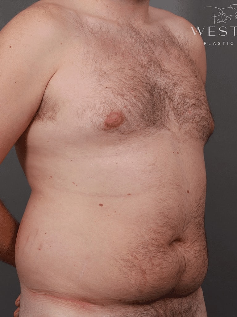 Liposuction Before & After