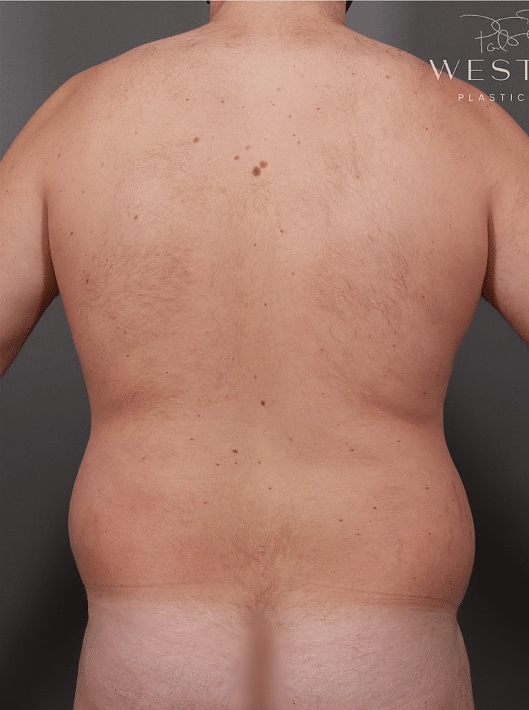 Liposuction Before & After