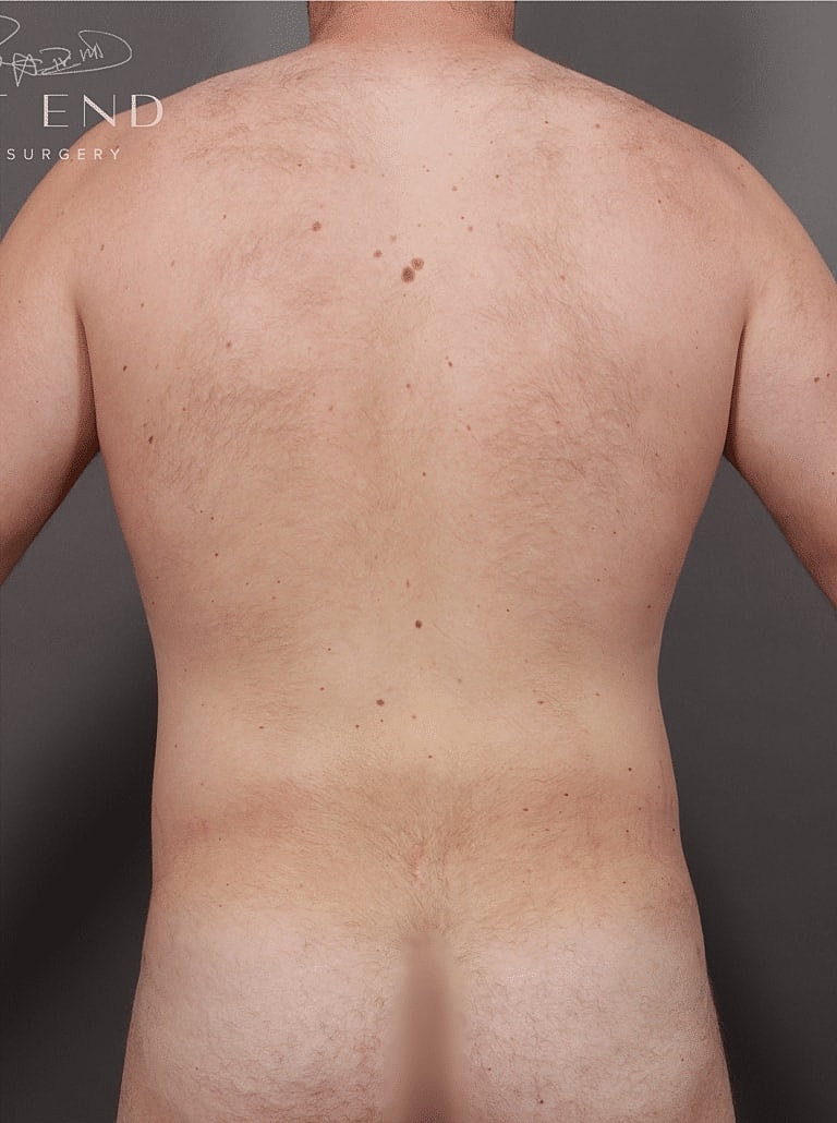 Liposuction Before & After