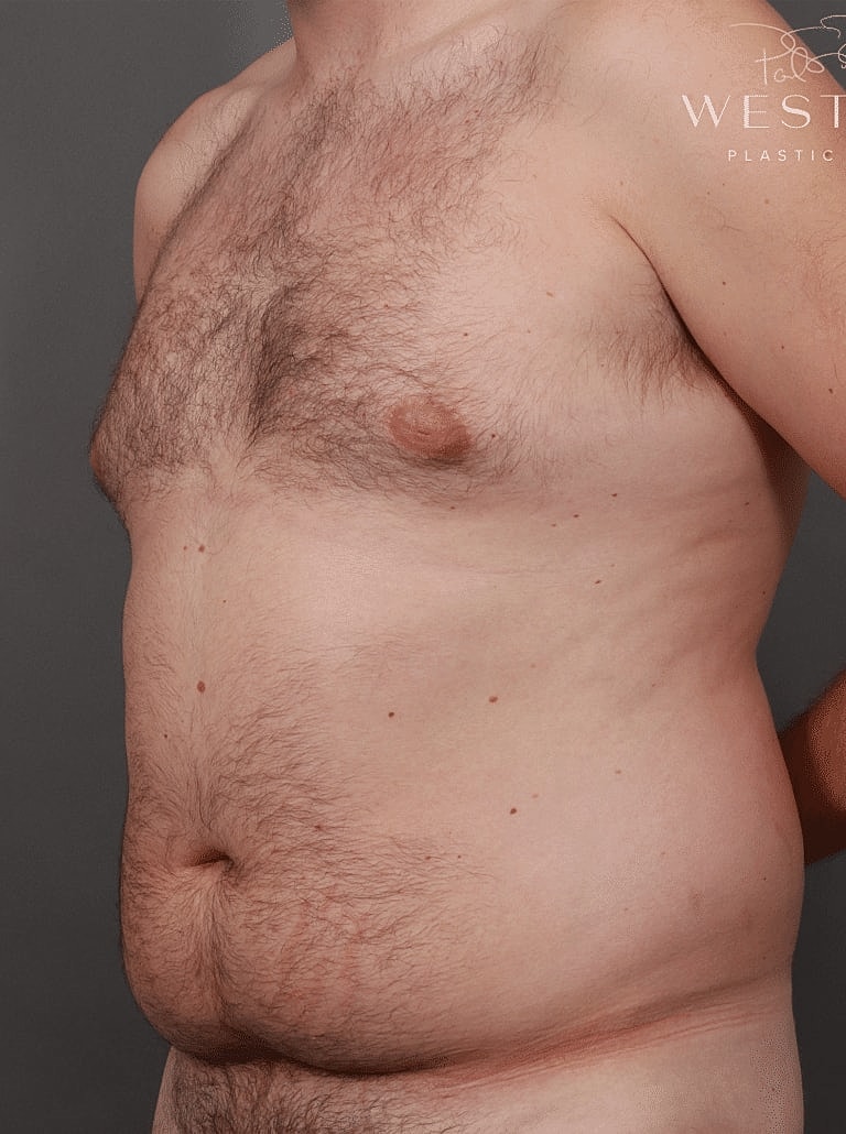Liposuction Before & After