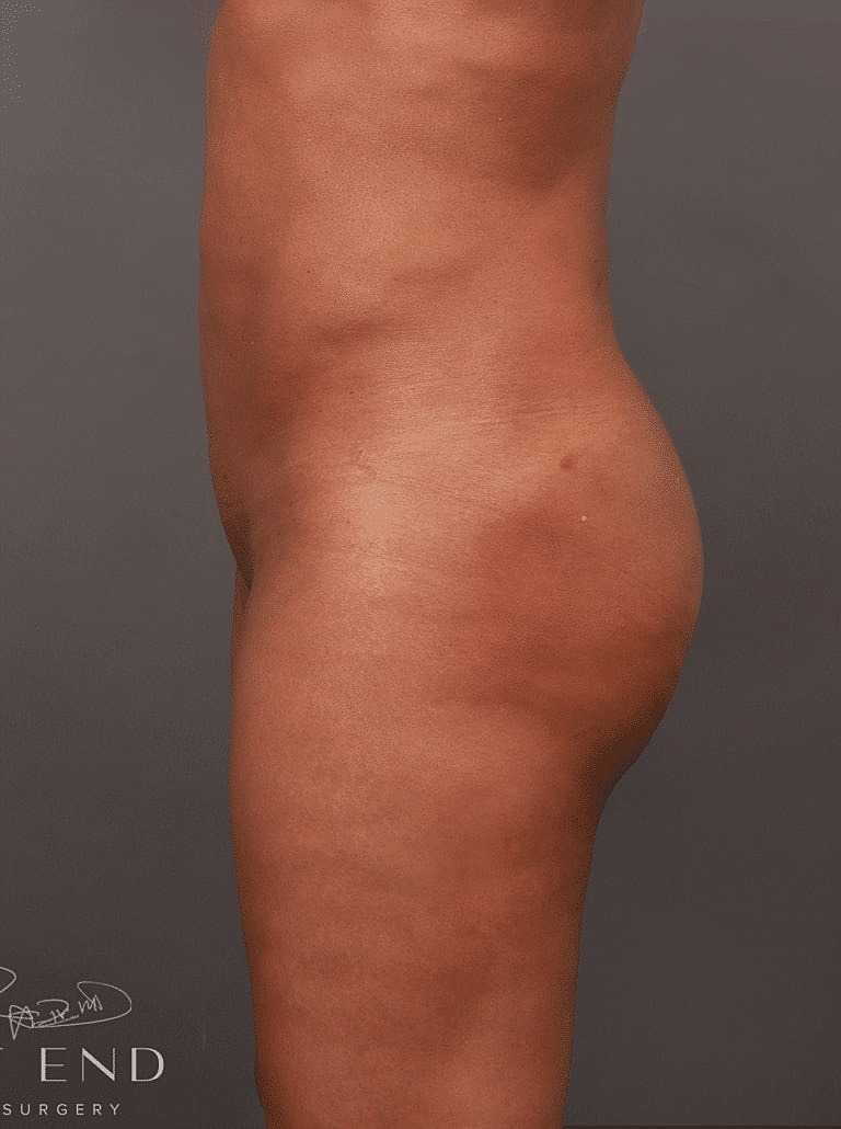 Liposuction Before & After