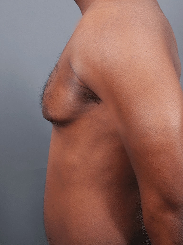 Liposuction Before & After