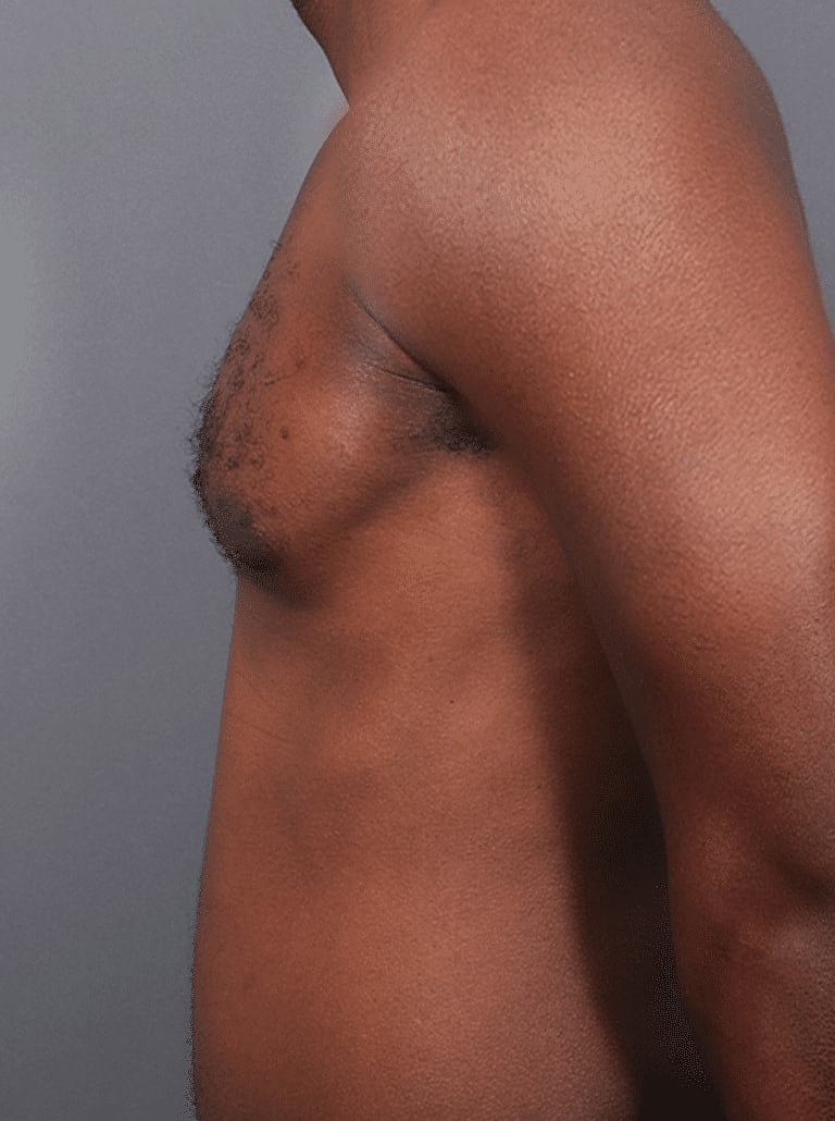 Liposuction Before & After