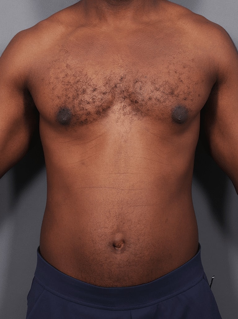 Liposuction Before & After